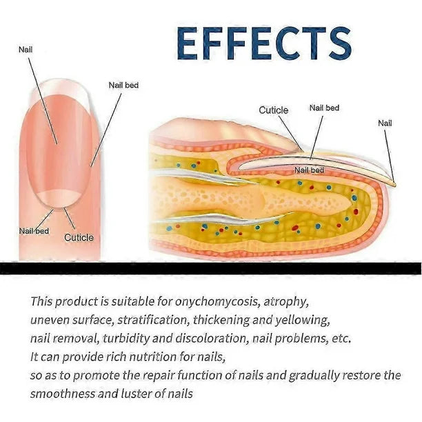 ¡Recupera la salud y belleza de tus uñas! Nuestros parches antifúngicos eliminan hongos de forma segura y efectiva mientras duermes. Resultados visibles en pocas semanas.
